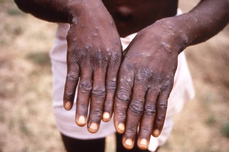 An image created during an investigation into an outbreak of monkeypox, which took place in the Democratic Republic of the Congo (DRC), 1996 to 1997, shows the hands of a patient with a rash due to monkeypox, in this undated image obtained by Reuters on May 18, 2022. —Handout via Reuters