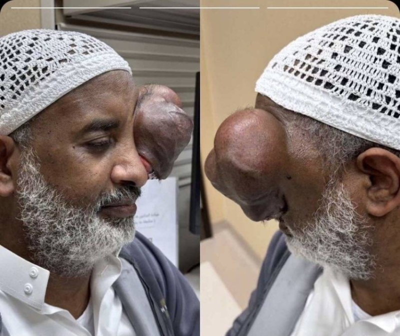 الدكتور السعودي هاني الجهني ينهي معاناة مقيم سوداني 2 2392494