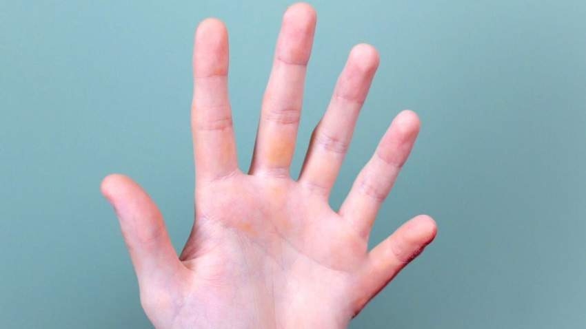 الأصبع الزائدة في اليد مفيدة