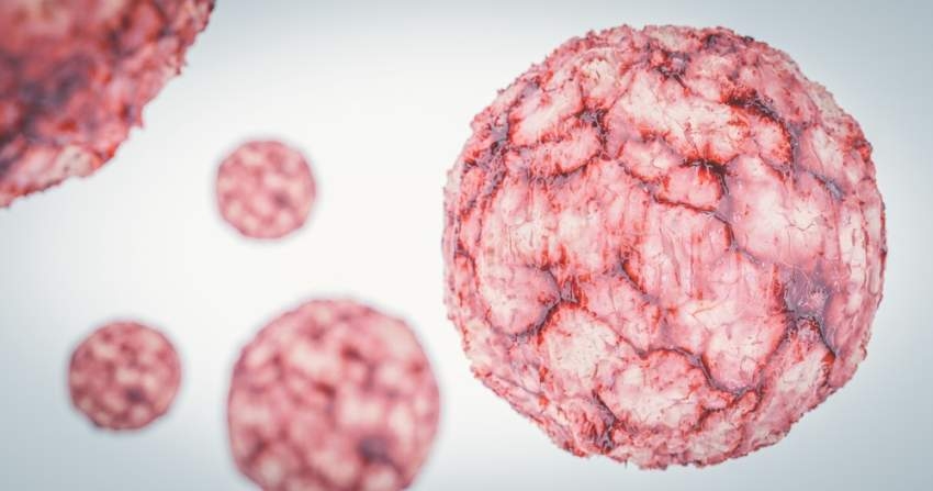 اكتشاف «خلايا مناعية فريدة» تحارب سرطان الثدي