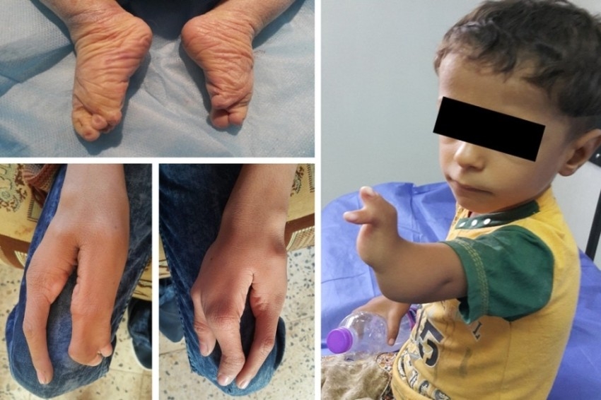 أطفال العراق.. تشوهات وأمراض خطيرة بسبب الغزو الأمريكي