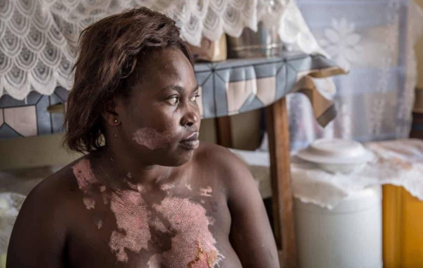«أدركت أن جسدي كان يحترق».. كورونا شاهد على وحشية الشرطة في أوغندا