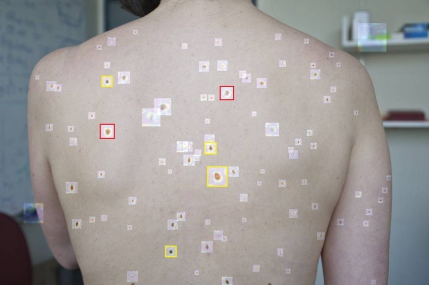 برنامج ذكاء اصطناعي يكشف عن سرطان الجلد