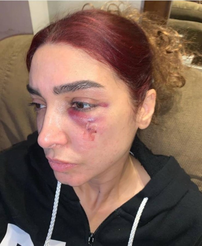 أول صورة لروجينا بعد إصابتها في الوجه