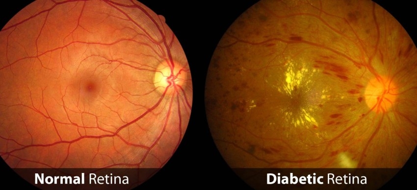 تقنية جديدة لحماية مرضى السكري من فقدان البصر