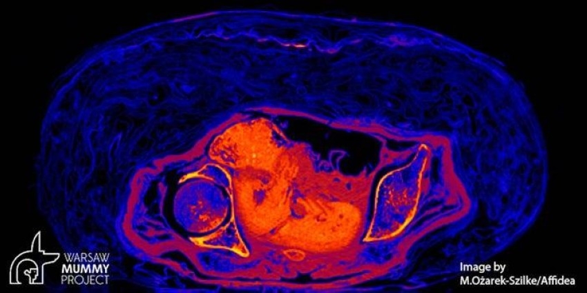 «المومياء الحامل».. تفسيرات جديدة لعدم اكتشاف مثيلاتها من قبل