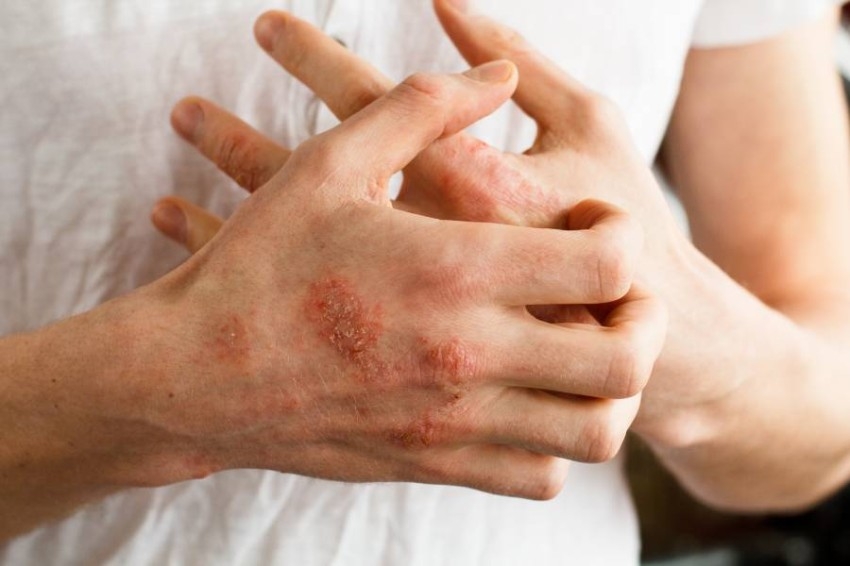 6 أعراض جلدية لمتحور «أوميكرون» قبل ظهور الأعراض التنفسية