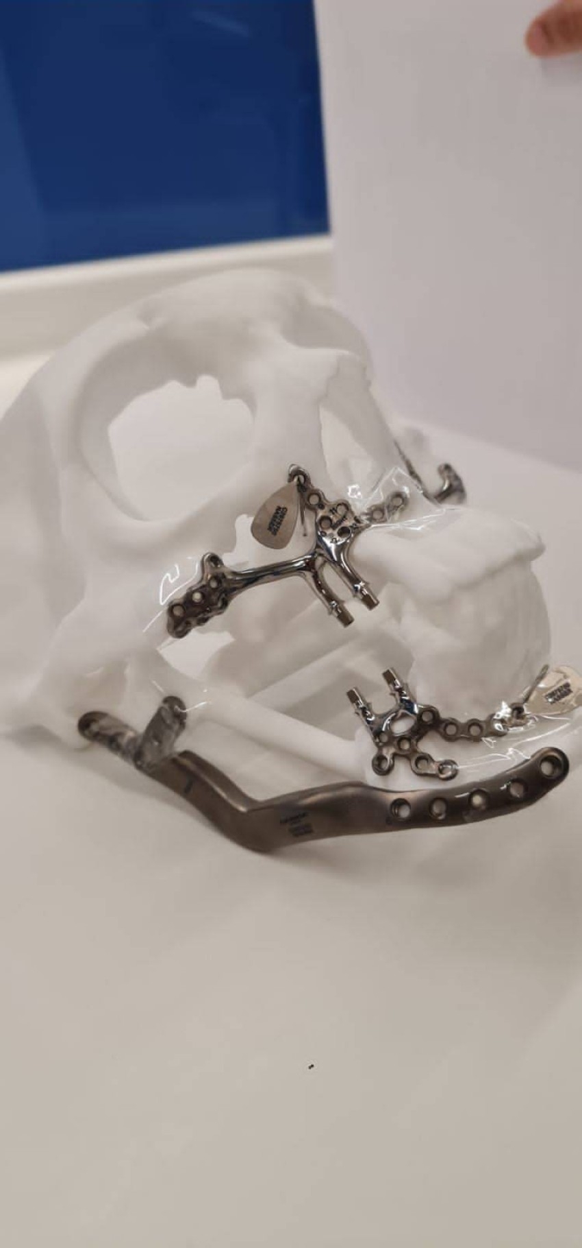 بناء عظام وجه مريض إماراتي بالطباعة 3D في دبي