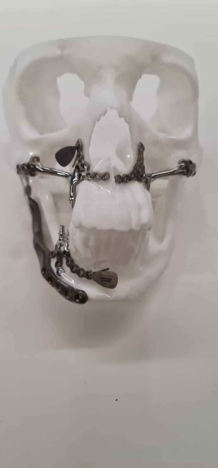 بناء عظام وجه مريض إماراتي بالطباعة 3D في دبي