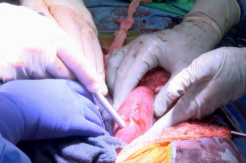 A pig kidney transplanted into a brain-dead male recipient