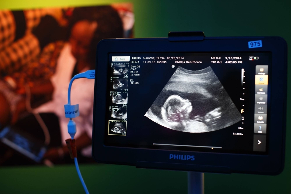 An image of a fetus on the screen of a portable ultrasound system.