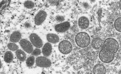 An electron microscopic image shows mature, oval-shaped monkeypox virus particles.