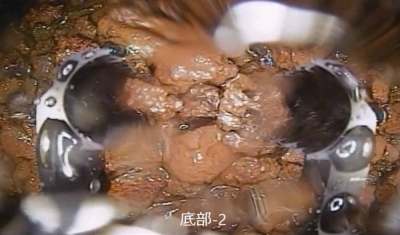 Materials that appear to be debris at the bottom of the containment vessel of the Fukushima No. 1 nuclear power plant's Unit 2 reactor.